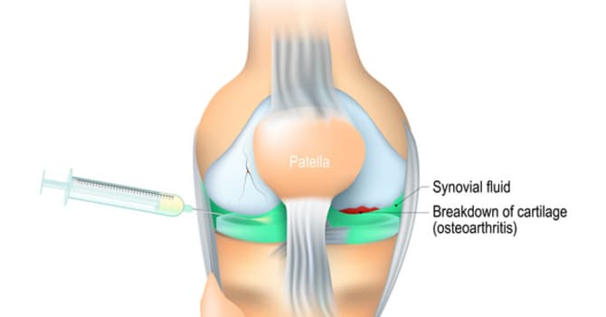 Non-Surgical Decompression
